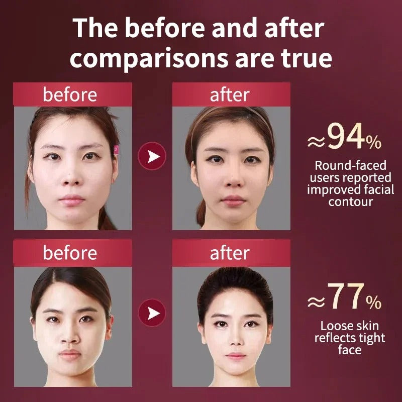 Facial Lifting Device